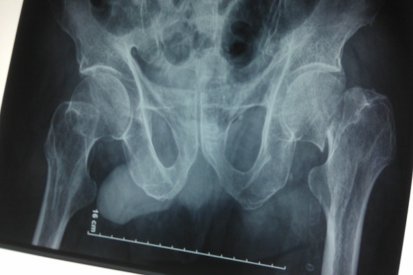 Gãy cổ xương đùi - Hình ảnh minh họa